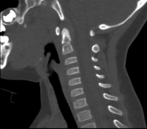Subaxial Cervical Spine Trauma In The Pediatric Patient Neupsy Key