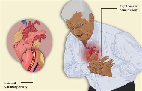 What Is Angina Pb Cardiovascular