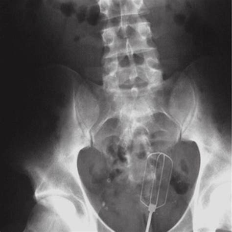 29 Shocking X Ray Images Of Rectal Foreign Bodies