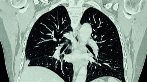 Radiomics Can Identify High Risk Early Stage Lung Cancer