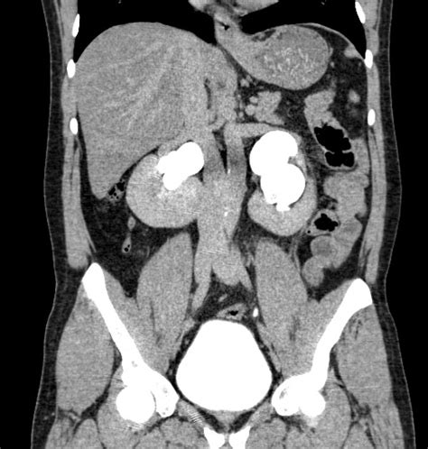 Horseshoe Kidney With Bilateral Renal Stones And Hydronephrosis Image