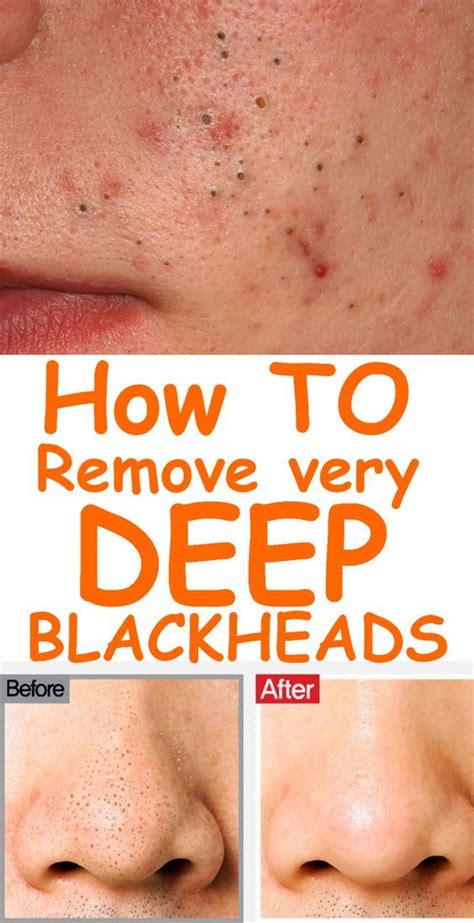 Blackhead Remover Mask Natural Ways To Remove Acne And Blackheads