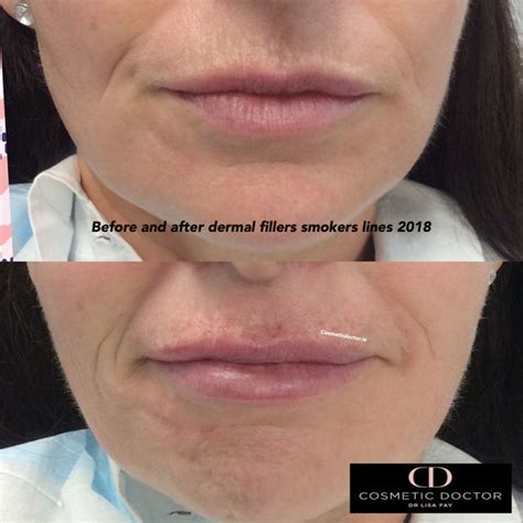Before After Lip Fillers Smokers Lines Cosmetic Doctor Dublin