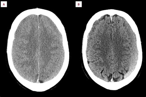 Computed Tomography Ct Scan Of Bilateral Chronic Subdural Hematoma