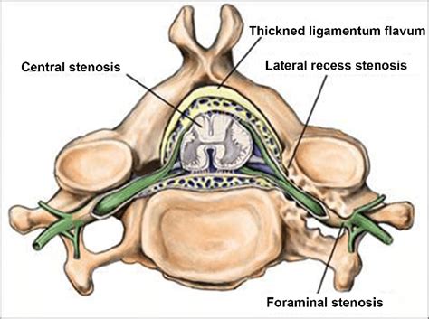Schematic Presentation Of Different Types Of Lumbar Spine Stenosis