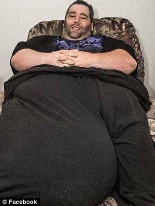 Dan Maurer With 80lb Scrotum Has 14 Hour Surgery To Remove The Giant