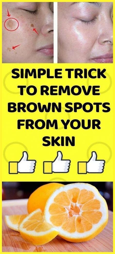 Remove Blackheads With One Simple And Effective Trick Sun Spots On Skin