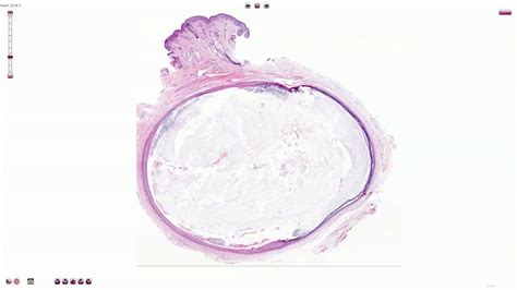 Epidermal Inclusion Cyst Histology