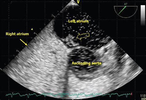 The Indian Academy Of Echocardiography Practice Guideline For The