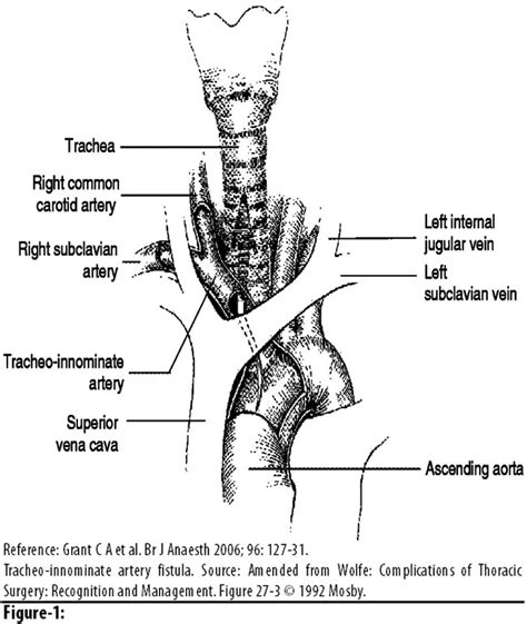 Tracheo Innominate Fistula Formation A Rare Complication Of Tracheostomy