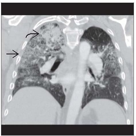 Wegener Granulomatosis Lung Radiology Key