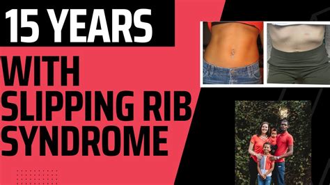 My Journey With Slipping Rib Syndrome Surgery And Recovery Rib Pain