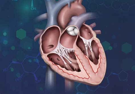 Sglt2 Inhibitor Use In Case Of Acute Decompensated Heart Failure