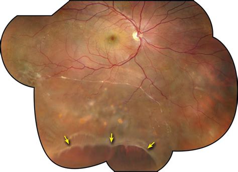Peripheral Retinal Degenerations And Rhegmatogenous Retinal Detachment