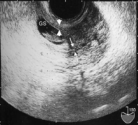 Transvaginal Ultrasound Image Of Scar Preg Nancy Case