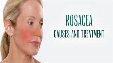 Rosacea Symptoms Causes And Treatment Youtube