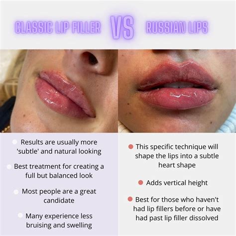What S The Difference Between Russian Lips And Normal Filler