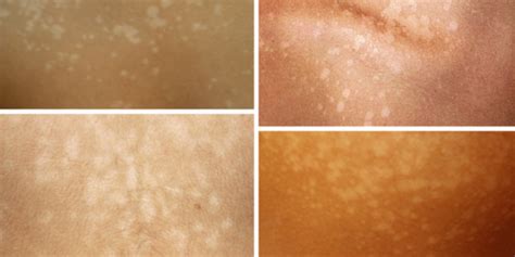 White Spots After Tanning Tinea Versicolor All Things Tanning