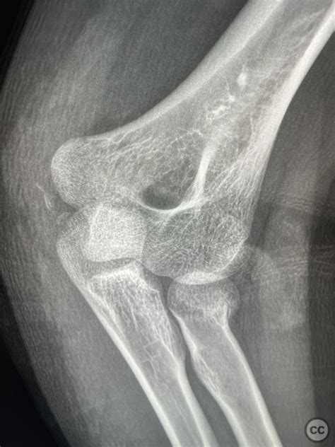 Radial Head And Incomplete Capitellum Fracture