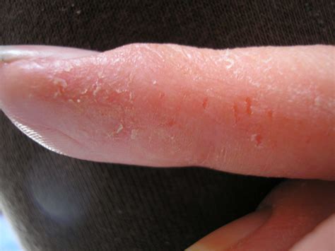 Eczema Bumps On Hands