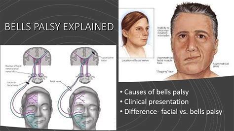 What Is Bells Palsy What Are Its Symptoms And Causes Difference