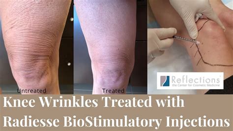 Knee Wrinkles Removed With Radiesse Sofwave And Defanage Tighten