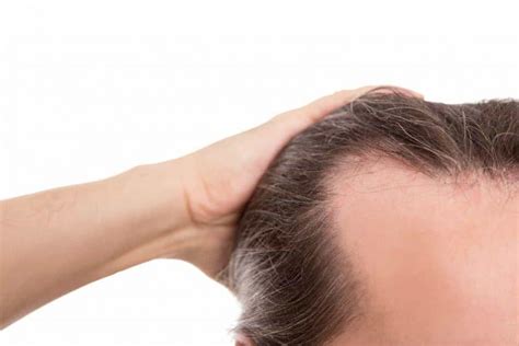 Is Your Hair Loss A Permanent Condition Hairlossable