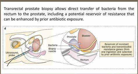 Targeted Antimicrobial Prophylaxis For Transrectal Prostate Biopsy