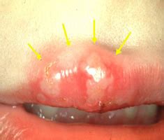 Find out about canker sores, those small but painful reddish ulcers in the mouth's lining. oral herpes (cold sore) vs apthous ulcer (canker sore ...