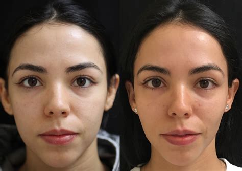 In the case of the vampire breast lift®, a series of two to three treatments is recommended for a rounder, fuller décolleté. Vampire Facial Treatment Helps in Rejuvenating your Face