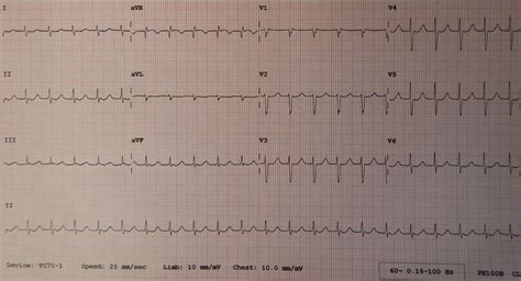 Junctional Tachycardia Narrow Qrs Complex And No P Waves Vagues Qrs