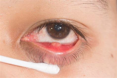 Internal stye what is it causes and treatment Área oftalmológica