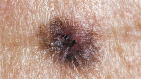 Skin Cancer Check Number Of Moles On Your Right Arm An Indicator Of Risk Experts Say