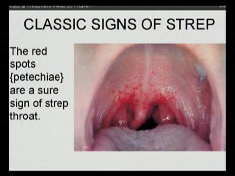 Healthy Living Coughs Up Details About Strep Throat