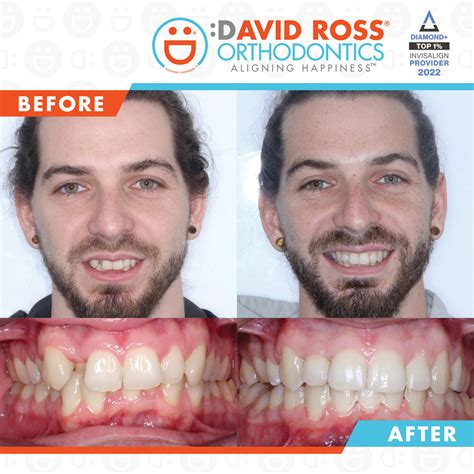 5 Facts About Clear Aligners David Ross Orthodontics