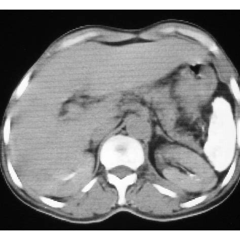 Abdominal Ct Scan Showing A Large Splenic Abscess Occupying The Whole