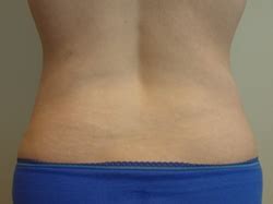 Tampa Bay Tumescent Liposuction Specialist Dr Andres Bonelli
