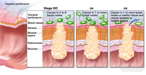 Signs And Symptoms Of Stage 4 Colon Cancer Understand How Colorectal
