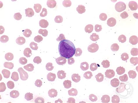 The word acute in acute myelogenous leukemia denotes the disease's rapid progression. AML with maturation - 2.