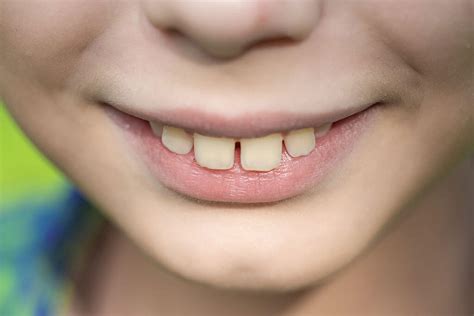 7 Common Bite Problems That Affect Children And Adults Davis Dental Care