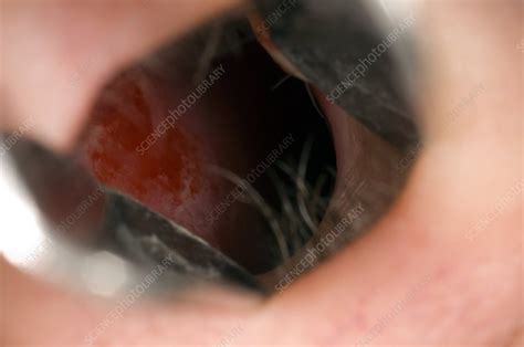 Inflamed Mucosa In The Nose Stock Image C0029599 Science Photo Library