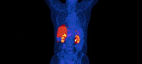 How Molecular Imaging Helps Predict Immunotherapy Response Tracer