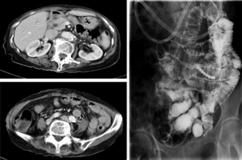 Enhanced Abdominal Ct Scan And Barium X─ray Of Small Intestine Showing