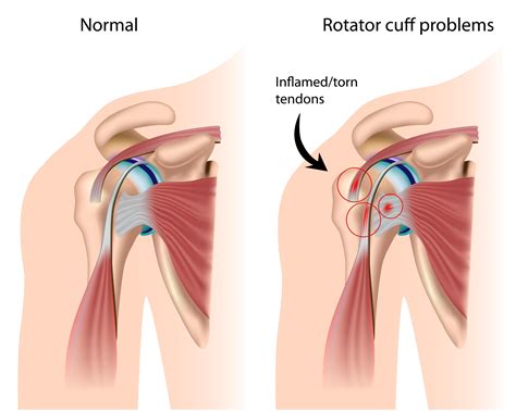 Questions Surrounding The Rotator Cuff Tear In Manny Pacquiaos Shoulder Dr David Geier