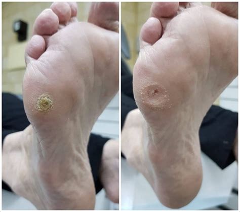Callous And Corns On Feet Similarities To Blisters Blister Prevention