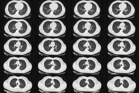 Lung Cancer Scans Are Recommended For People 50 And Older With Shorter