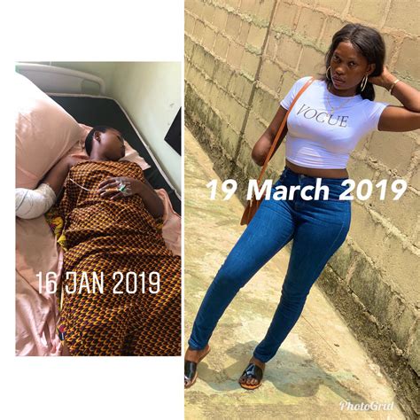 Nigerian Lady Whose Arm Was Amputated Months Ago Shares Recovery
