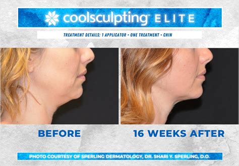 Submental Fat Coolsculpting Before And After Patient 26 Sperling