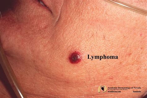 Cutaneous Lymphoma Please Contribute To The Leukemia And Lymphoma