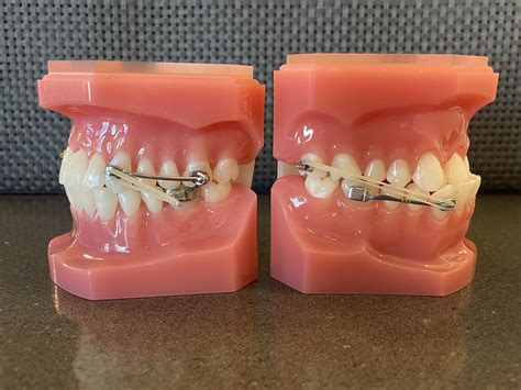 What Is A Carriere Appliance And How Is It Used — Cook Orthodontics Of Dublin